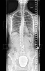 x-ray-full-spine-diagnostic-imaging-melbourne 2.jpg